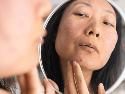 پوشاندن لکه های صورت با ارایش