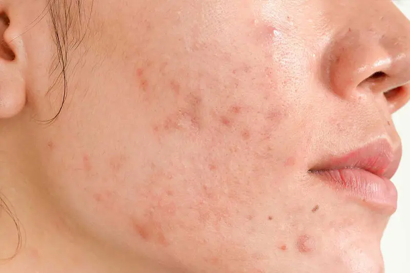 یک نکته مهم: مراقب خشکی بیش از حد باشید