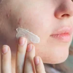 بهترین ضد آفتاب برای پوست چرب و جوشدار