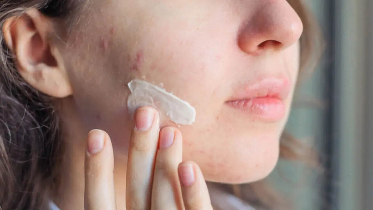 بهترین ضد آفتاب برای پوست چرب و جوشدار